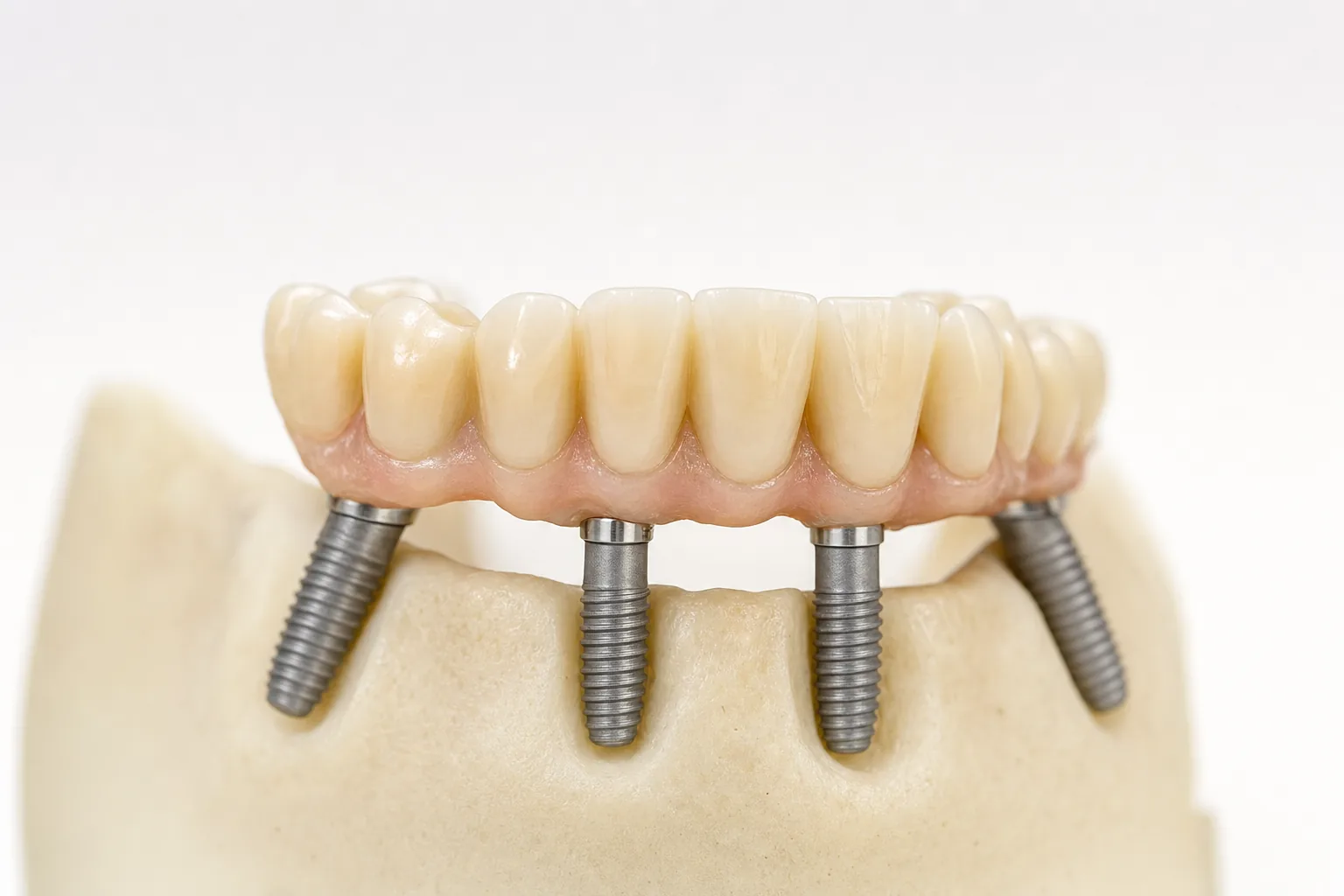 All-on-4 MALO Bridge mit geneigtem hinterem Implantat in der Seitenansicht