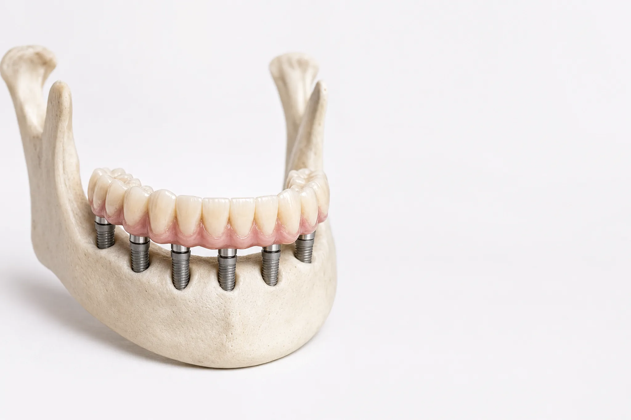 All-on-6 Implantate mit festsitzender Br&uuml;cke auf sechs Implantaten