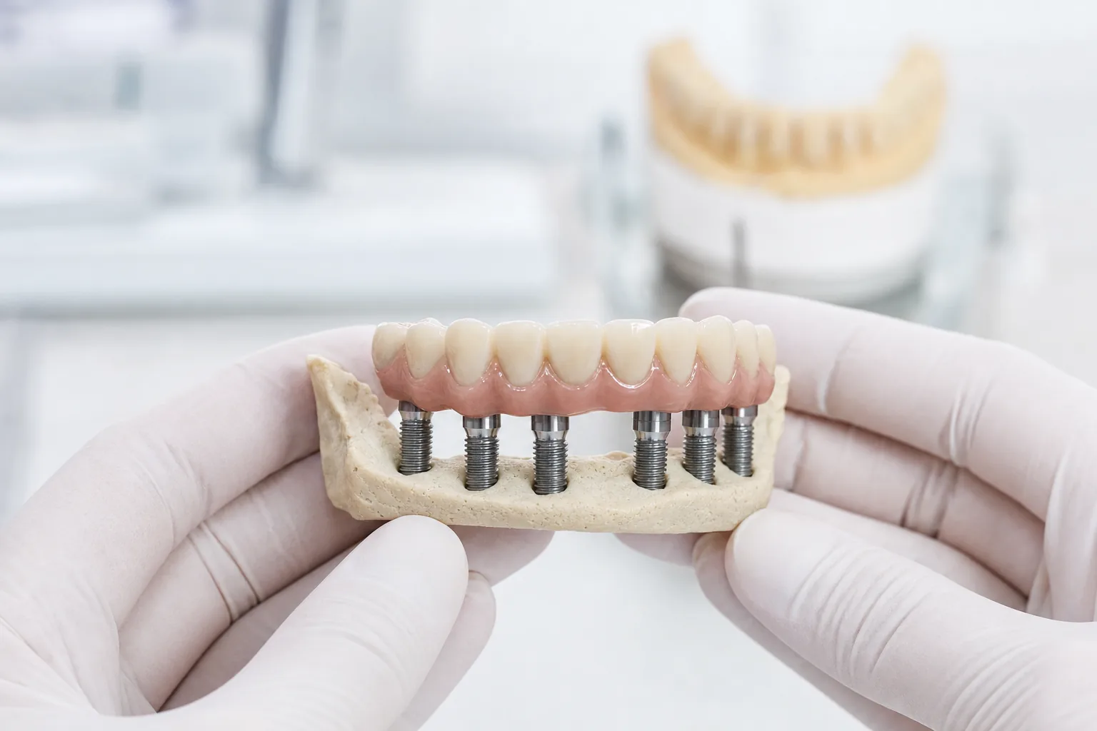 Fertigung einer festsitzenden Implantatbr&uuml;cke im eigenen Meisterlabor