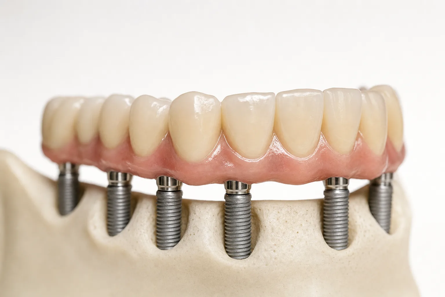 Festsitzende MALO Implantatbr&uuml;cke in der Seitenansicht
