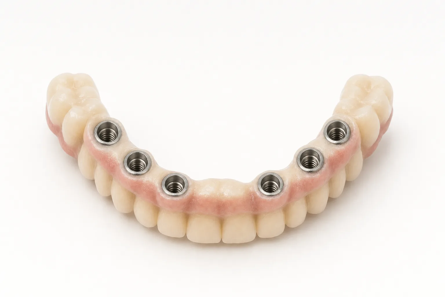 Unterseite einer verschraubten MALO Implantatbr&uuml;cke mit sechs Verbindungen