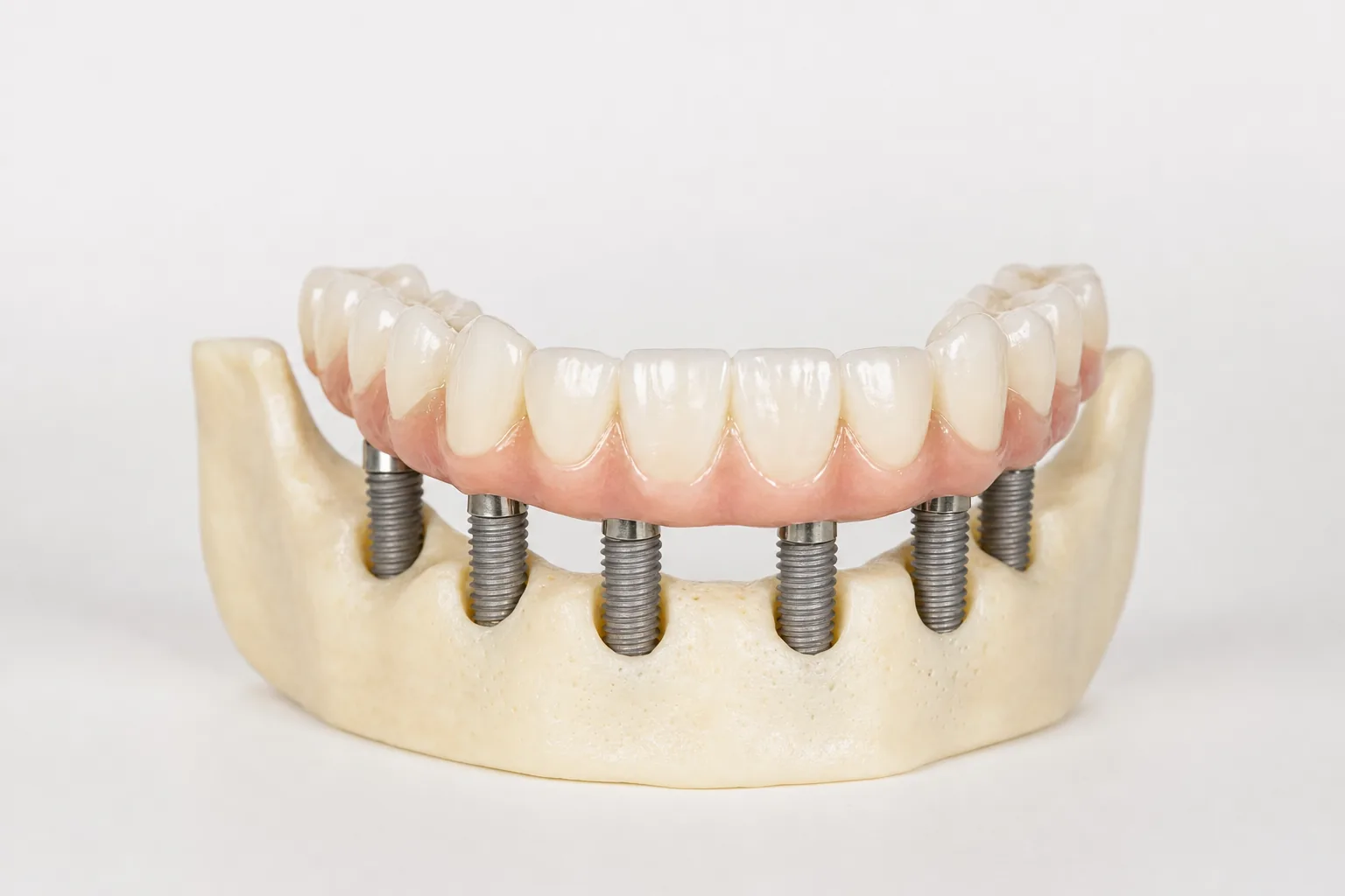Festsitzende Implantatbr&uuml;cke auf sechs Implantaten