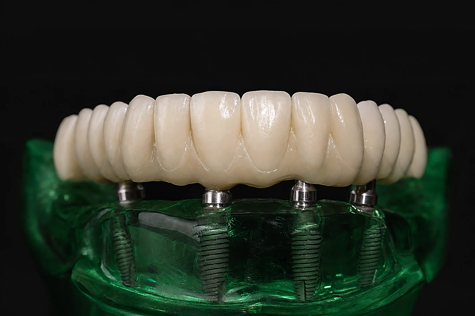 Feste Zähne auf Implantaten, All-on-4